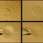 Intracytoplasmic Sperm Injection (ICSI)