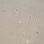 Antisperm Antibodies